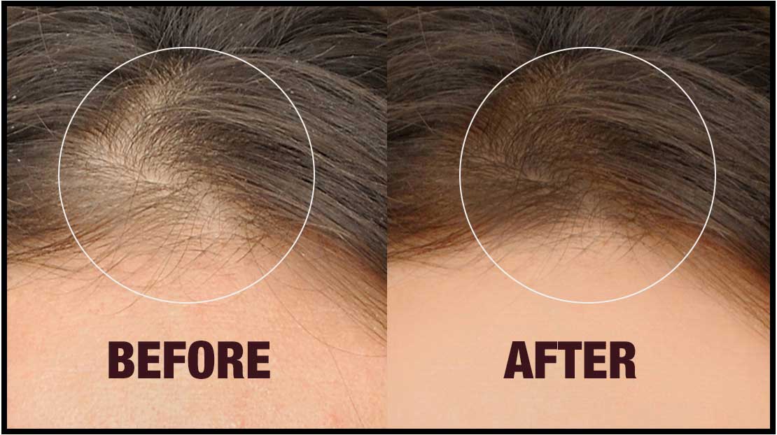 Follinique product result image